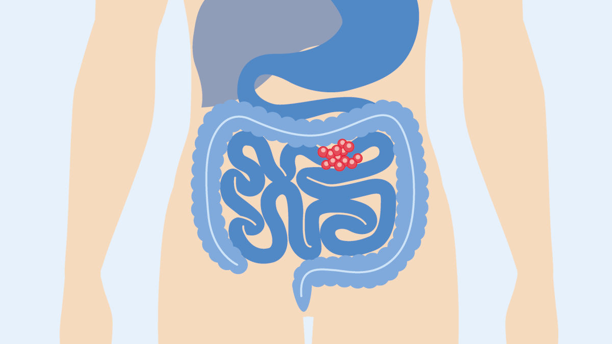 GIST treatment decisions you can have confidence in